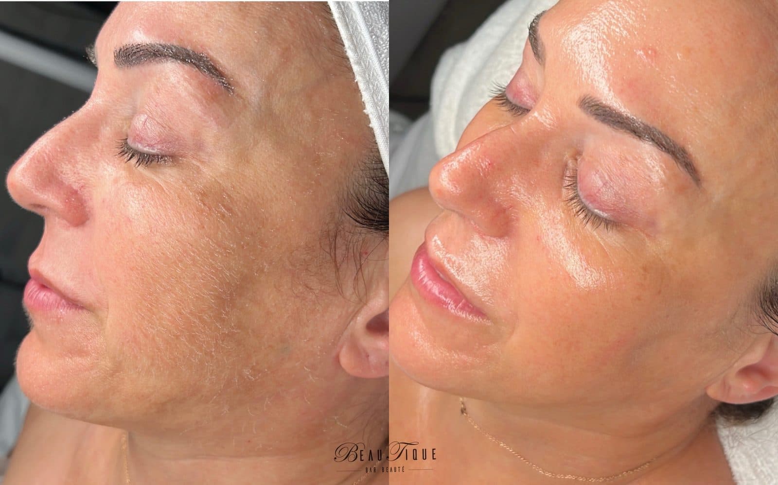 Dermaplaning : la peau avant, à gauche, et après, à droite, plus lumineuse