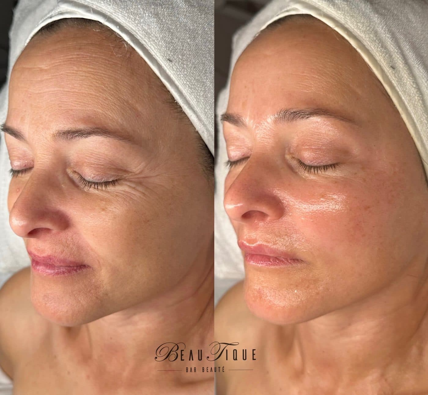 Peeling chimique : la peau avant, à gauche, et après, à droite
