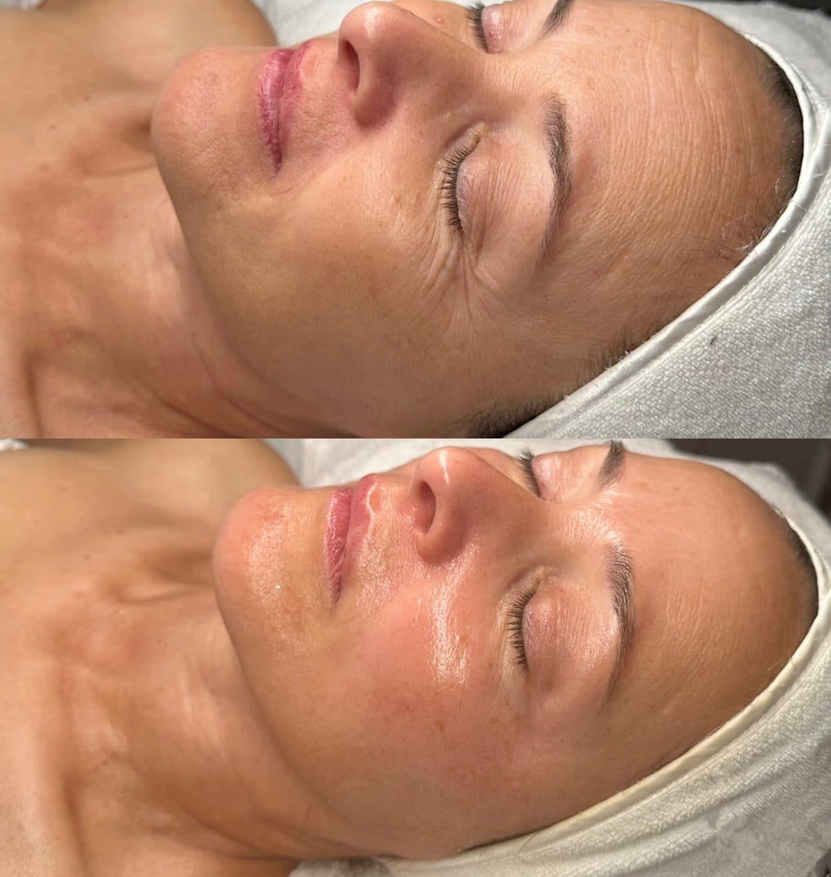 Peeling chimique : la peau avant, en haut, et après, en bas
