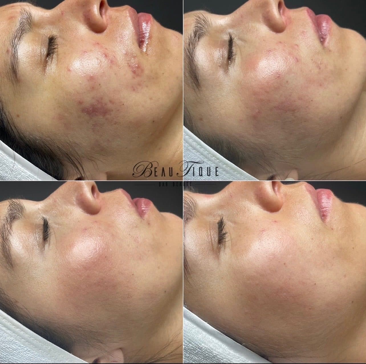 Soin pour peau acnéique : quatre photos de la même peau; les imperfections sont nettes en haut à gauche et presque disparues en bas à droite