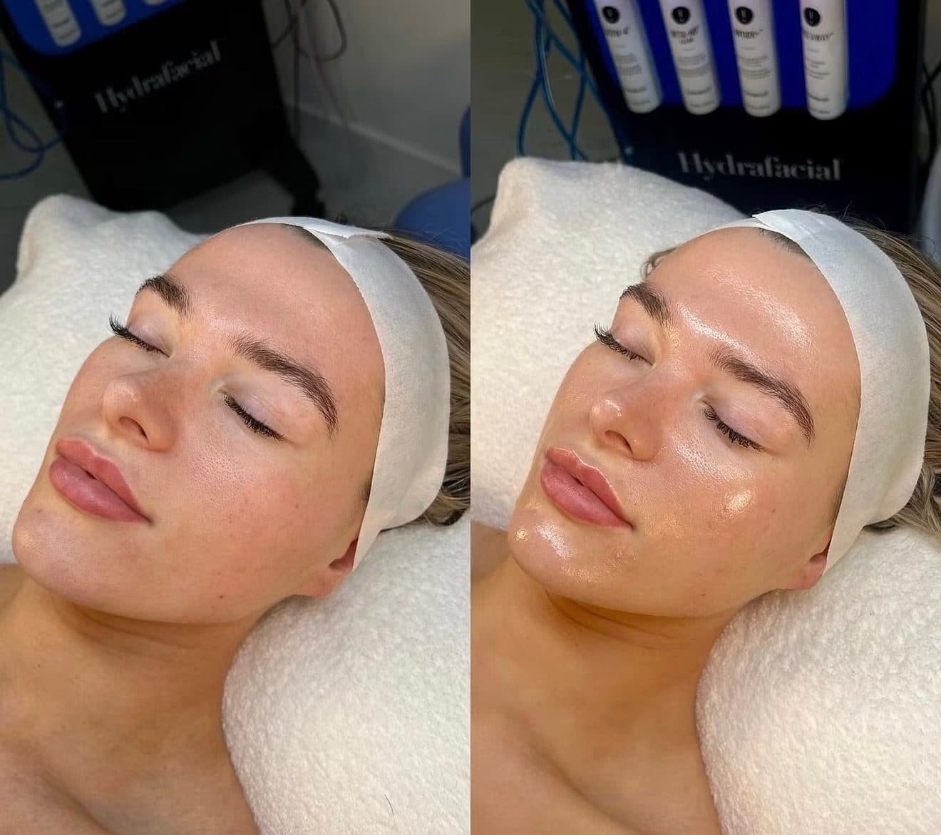 Hydrafacial MD : la peau avant, à gauche, et après, à droite, plus lumineuse et plus unie