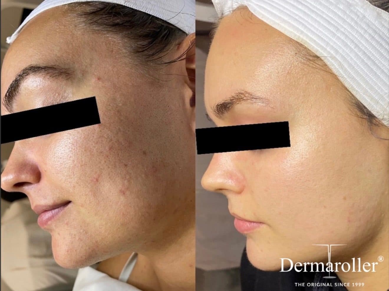 Microneedling eDermaStamp : la peau avant, à gauche, avec des marques et des rougeurs, et après, à droite, plus lisse