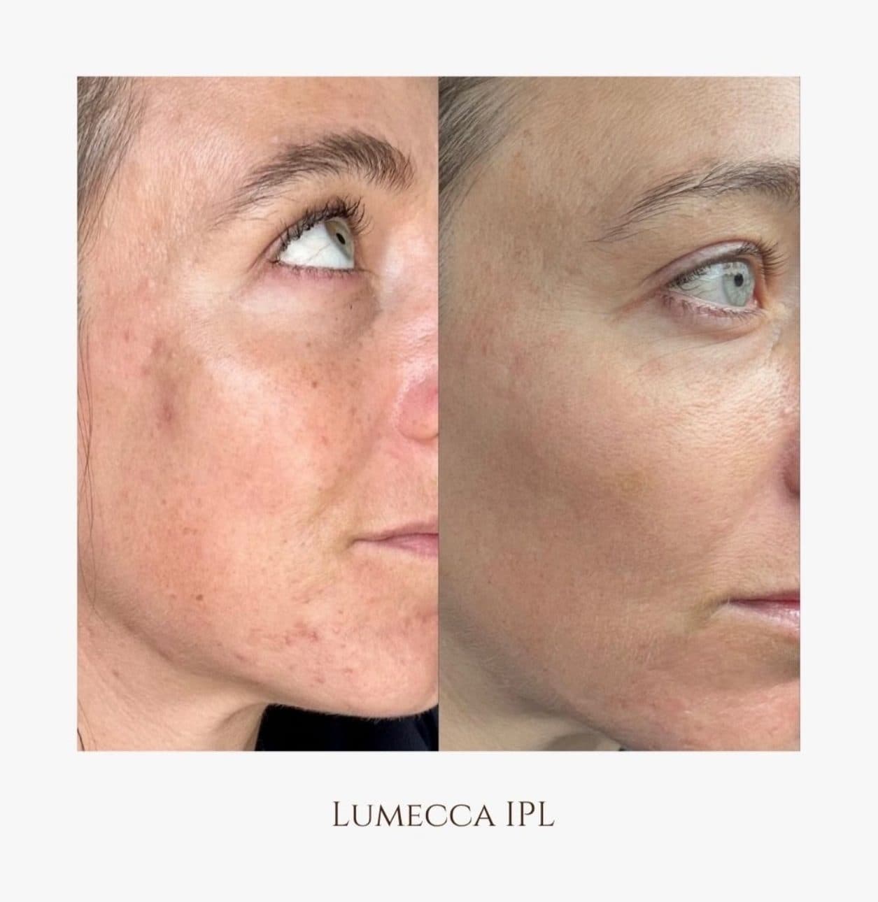 Lumecca IPL sur le côté du visage : les taches et le teint inégal avant, à gauche, et après, à droite