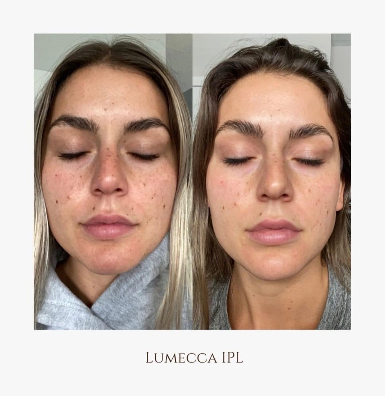 Lumecca IPL sur un visage : les taches de rousseur et les rougeurs avant, à gauche, et après, à droite